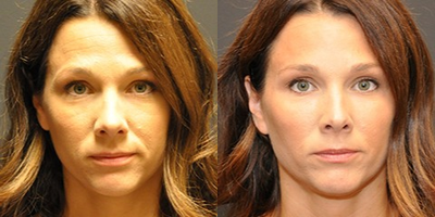 35-44 year old woman treated with Perlane - Injectable Filler