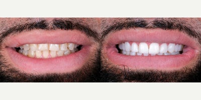 35-44 year old man treated with Dental Crown - This patient wanted to restore the worn, discolored look of his front teeth. We used crowns to rebuild shape, close small gaps, and create a clean, natural finish. The result is a more confident smile that still feels like himjust refreshed.