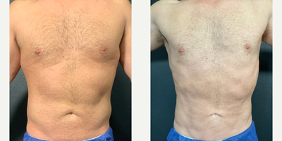 Man treated with Vaser Liposuction - Man treated with Vaser Liposuction- 3 months post-op