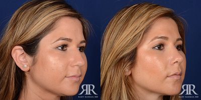 Rhinoplasty - Rhinoplasty
