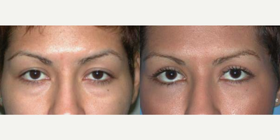 Woman treated with Eyelid Surgery - Woman treated with Eyelid Surgery