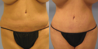 25-34 year old woman treated with Tummy Tuck Revision - improved high scar, visible pubic hair, silhouette shape and stomach flattening