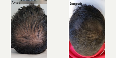 Man treated with Hair Loss Treatment - Recover and strengthen your hair if it is possible! In our office, you will find different treatments focused on hair strengthening and recovery. Treatments that depend on consistency and time! But the perfect solution to get your scalp back.