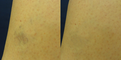 18-24 year old woman treated with Sclerotherapy - 19 year old before and after 2 laser vein removal sessions. Patient was happy with her result.