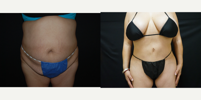 45-54 year old woman treated with Tummy Tuck, Brazilian Butt Lift - Patient was unhappy with over all body contour after multiple pregnancies and weight gain. Patient was treated with abdominoplasty and liposuction 360 with a fat transfer to buttocks.