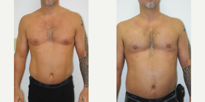 35-44 year old man treated with Pec Implants, Gynecomastia Surgery - 37 year old male 6 months after correction gynecomastia and pectoral implants performed by Dr Sam Gershenbuaum. He requested reduction of his gynecomastia and more fullness in his upper chest, but in a conservative fashion.This can best be seen by the side profile image. After liposuction was used to correct his gynecomastia, he had Implantec soft solid silicone vertical rectangular implants placed under the muscle. He was very pleased with his results.