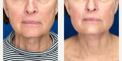 65-74 year old woman treated with Contour Thread Lift, Endolift, Nonsurgical Facelift, Nonsurgical Neck Lift - Non-Surgical Face and Neck Lift using Endolift Laser in combination with PDO Threads. The Endolift tightens lax skin, stimulates your skin collagen for a vibrant skin tone and contours unwanted fat. In combination with the PDO Threads that reposition fallen tissue and also stimulates collagen. Both procedures are outpatient with minimal discomfort or downtime. The entire procedure is done through tiny pin holes so there is no surgical scars. A natural revitalization and rejuvenation.