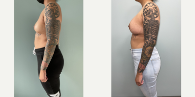25-34 year old woman treated with Breast Augmentation, Sientra Breast Implants - Breast Augmentation Surgery performed, Silicone Implants under the muscle 440cc High Profile.