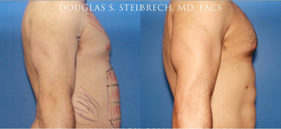 Man treated with Bicep Implants - Man treated with Bicep Implants