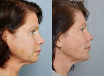 55-64 year old woman treated with Chin Implant - This patient received a chin implant for a receding chin.