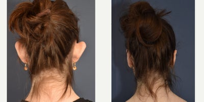Woman treated with Ear Surgery - Woman treated with Ear Surgery