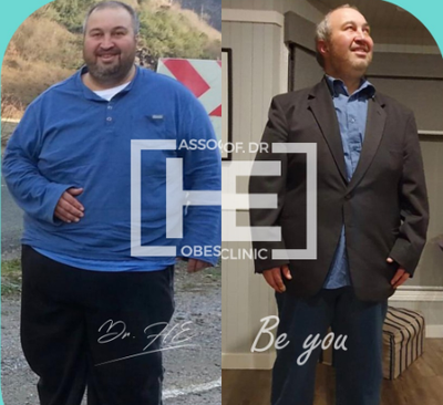 45-54 year old man treated with Gastric Bypass - He lost 60 kilos in 18 months. He has good results like our other patients.
