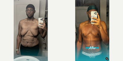 Man treated with Gynecomastia Surgery - Heres some math for you: 365 days after his 360-degree tummy tuck, full tummy tuck, upper back lift, and gynecomastia surgery, this patient has done a 180 to live his best life.