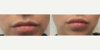 18-24 year old woman treated with Lip Augmentation - This young girl already had nice lips but wanted them a bit more full. We used restylane.&nbsp;