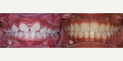 Damon Braces - Treated with damon braces - No extractions or appliances.