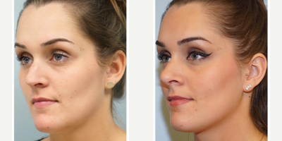 25-34 year old woman treated with Revision Rhinoplasty - This young ex-cheerleader suffers from stuffiness and whistling from the nasal septal perforation sustained from improperly healed nasal injury. Temporalis fascia graft is used to patch the hole in the septum. Previous nasal intervention is related to nasal trauma suffered from cheerleading.