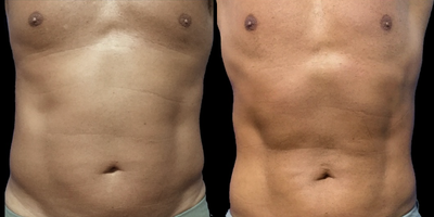 Man treated with truSculpt - Man treated with truSculpt