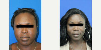 25-34 year old woman treated with Facial Feminization Surgery - 25-34 year old woman treated with Facial Feminization Surgery