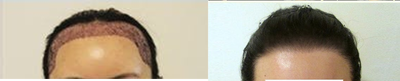 25-34 year old woman treated with Hair Transplant - 2000-2500 grafts female hair transplant