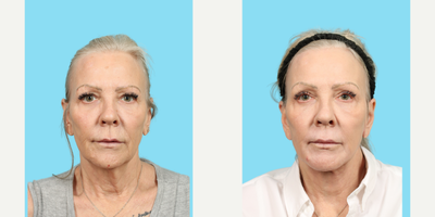 63 year old woman treated with Phenol Peel - This 63-year-old woman was bothered by droopy eyes, lip lines around her mouth and a sagging jawline. The doctor performed facelift, neck lift, upper blepharoplasty and a phenol chemical peel around her mouth. Her results are dramatic and she looks 10 years younger.