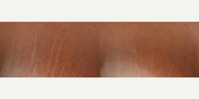 Woman treated with ResurFX - Photo provided courtesy of Lumenis, Ltd., performed by Matteo Tretti Clementoni, MD