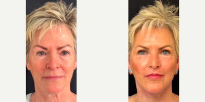 Woman treated with Neck Lift - Woman treated with Deep Plane Facelift, Neck Lift, Facial Fat Transfer, and Lip Lift.