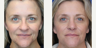 Woman treated with Rhinoplasty - Rhinoplasty