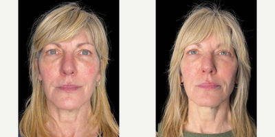Patient treated with Sylfirm X - Patient treated with Sylfirm X