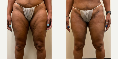 Thigh Lift - Thigh lift female before and after
