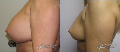 45-54 year old woman treated with Breast Implant Removal - 6 months after implant removal