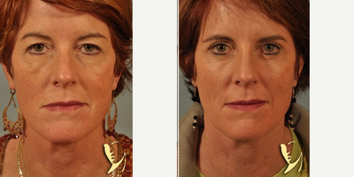 45-54 year old woman treated with Phenol Peel - HETTER PEEL SKIN RESURFACING, Baker-Gordon Phenol Peel by Burke Robinson MD, FACS