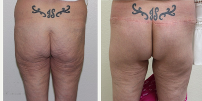 Butt lift - This 45 year old, very outgoing female, underwent a buttock lift to improve her appearance when wearing a swimsuit.&nbsp; Photographs shown are at her 6 week follow up. The scar will continue to fade.