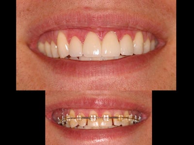 Whitening and porcelain veneers - Male aged 26.&nbsp; After having orthodontic treatment to correct his bite, our patient wanted to have the gaps between his teeth closed and wanted a more uniform, brighter smile.&nbsp; We whitened his teeth with our AcquaBrite in-office whitening system, then did 4 conservative, minimal prep DURAthin porcelain veneers (like Lumineers).&nbsp;