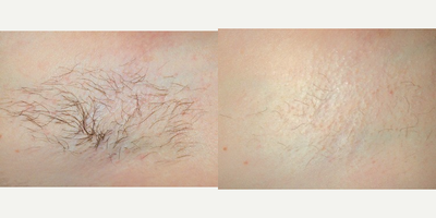 25-34 year old woman treated with Laser Hair Removal - Armpits treated with laser hair removal.