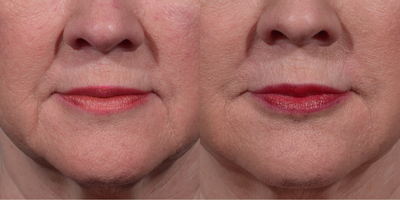 55-64 year old woman treated with Radiesse - Lower face Radiesse treatment of nasolabial folds and marionette lines