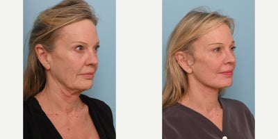 55-64 year old woman treated with Deep Plane Facelift, Neck Lift, Brow Lift, Eyelid Surgery, Facial Fat Transfer, CO2 Laser - Our patient came to us seeking a natural, refreshed lookhoping to restore youthful contours to her cheeks and eliminate excess skin. The results of her transformation are truly remarkable. Her jawline is now beautifully defined, volume has been restored to her face, and her skin appears firmer and naturally rejuvenated. To achieve this outcome, Dr. Balikian performed a comprehensive facial rejuvenation procedure, which included a preservation deep plane facelift, deep vertical neck lift with submandibular gland reduction, temporal brow lift, bilateral upper blepharoplasty, full face fat transfer, and full face CO2 laser. Each component of this tailored approach worked in harmony to produce balanced, natural-looking results that reflect Dr. Balikians artistry and expertise.