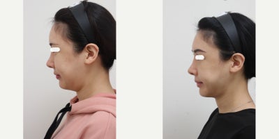 25-34 year old woman treated with AccuLift, Liposuction, Laser Liposuction - 26 Years old female patient Chief Complain: Puffiness and the lack of jaw contours, round shaped face (looking for V-line) Treatment Plan: ace liposuction (double chin, cheek bone, cheeks, near mouth)Outcome: pure fat liposuctioned : double chin (-20cc), middle face line (- 40cc) fresher look, V-lined face shape, more refined appearance