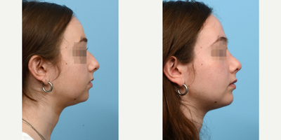 18-24 year old man treated with Chin Surgery - This patient underwent a combination rhinoplasty and chin augmentation surgery to improve her facial symmetry. 8 weeks post-op, she's thrilled with the outcome.
