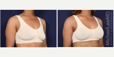 35-44 year old woman treated with Mentor Breast Implants - Breast augmentation. Follow-up photos taken 1 month after the procedure.
