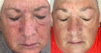 55-64 year old woman treated with DefenAge - Woman with sun damage/hyperpigmentation and wrinkles started using Defenage and below are her results after 4 weeks. Her wrinkles and hyperpigmentation are dramatically improved. She even has improvement of the texture of her skin. No other treatments were used in these 4 weeks other than the use of Defenage.