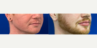 25-34 year old man treated with Lip Augmentation - After multiple syringes of filler over the course of 1 year done by PA Steve.