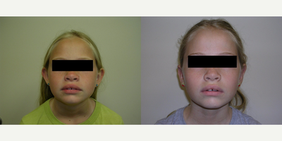 17 or under year old woman treated with Ear Surgery - 9 year old female shown before and six weeks after a bilateral otoplasty (ear pinning). The excess cartilage was removed and the upper pole of the ear was scored and sutured back to hold in position. All procedures done by Frank J. Ferraro, MD