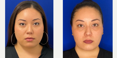 25-34 year old woman treated with Botox for TMJ - Our patient desired a slimmer lower face. Botox was used to treat the Masseter muscle to cause a slimming effect. Full results are seen after 2 weeks.