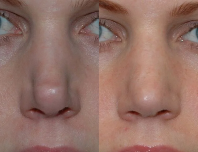 Revision Rhinoplasty - 	This young woman had bossae (plural of bossa), a common contour deformity of the tip of the nose, as well as an overly upturned and over-projected tip, both as a result of her original rhinoplasty procedure years ago. She underwent revision rhinoplasty to help correct these problems and to regain an elegant and natural contour to her nose.