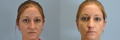 27 year old female who had  nose reshaping  - 
	This 27 year old was treated for a rhinoplasty and a septoplasty. Her photos were taken at 3 months post op.
