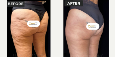 45-54 year old woman treated with Aveli - We have been receiving amazing results with combination therapy using our Aveli Tool & Sylfirm X device to improve the appearance of cellulite dimples and skin laxity. We always want to be transparent with our clients - So today we wanted to talk about the downtime for our newest Cellulite Solution.