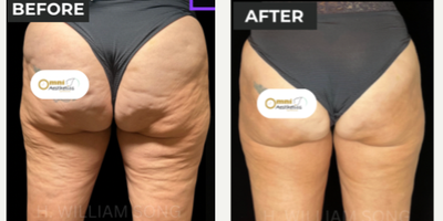 45-54 year old woman treated with Aveli - We have been receiving amazing results with combination therapy using our Aveli Tool & Sylfirm X device to improve the appearance of cellulite dimples and skin laxity. We always want to be transparent with our clients - So today we wanted to talk about the downtime for our newest Cellulite Solution.