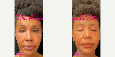 Woman treated with Moxi - Woman treated with ONE Moxi laser treatment.