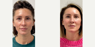 Woman treated with Halo Laser - Woman treated with Halo Laser