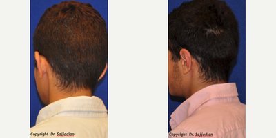 Ear Surgery - Ear Surgery